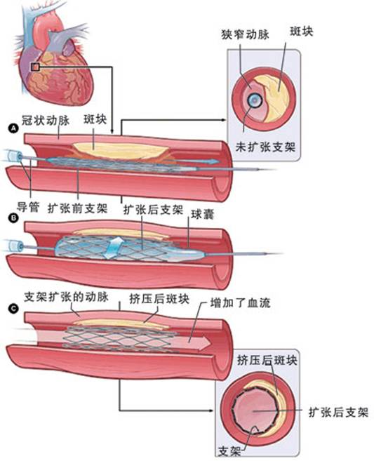 怎樣治療冠心病？(圖2)